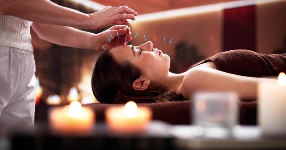 Facial acupuncture treatment with acupuncture needles applied to the forehead for relaxation, wellness, and traditional Chinese medicine therapy.