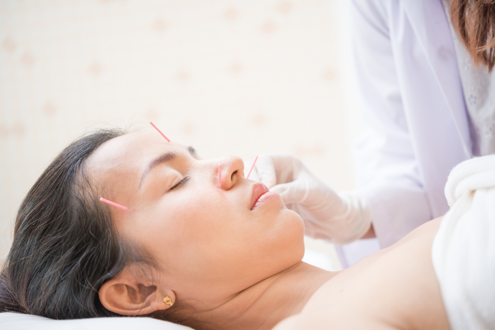 A practitioner in a white coat and gloves placing pink acupuncture needles on a woman's forehead, cheek, and nose area as she lies with her eyes closed on a treatment table.