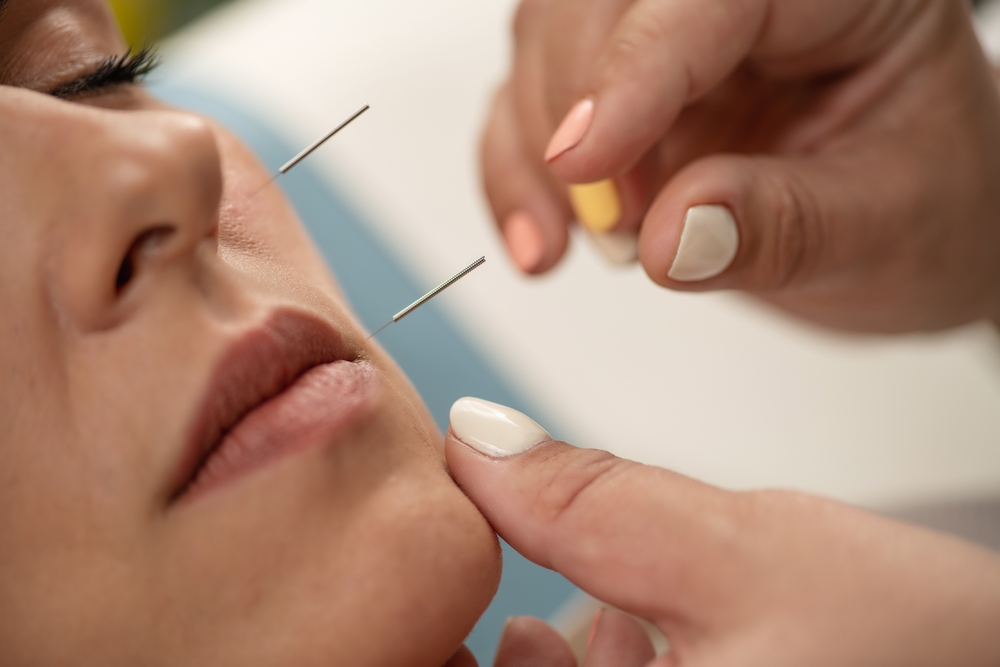 A close-up of a practitioner's hands carefully placing acupuncture needles along a woman's cheek and upper lip area during a facial acupuncture treatment.