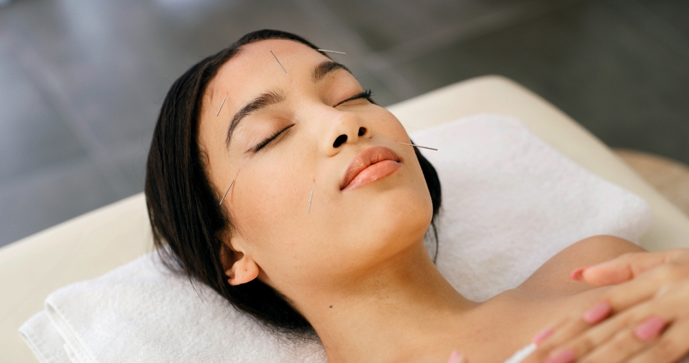 A woman lying on a treatment table with her eyes closed and multiple thin acupuncture needles placed across her forehead, cheeks, and jaw during a facial acupuncture session.