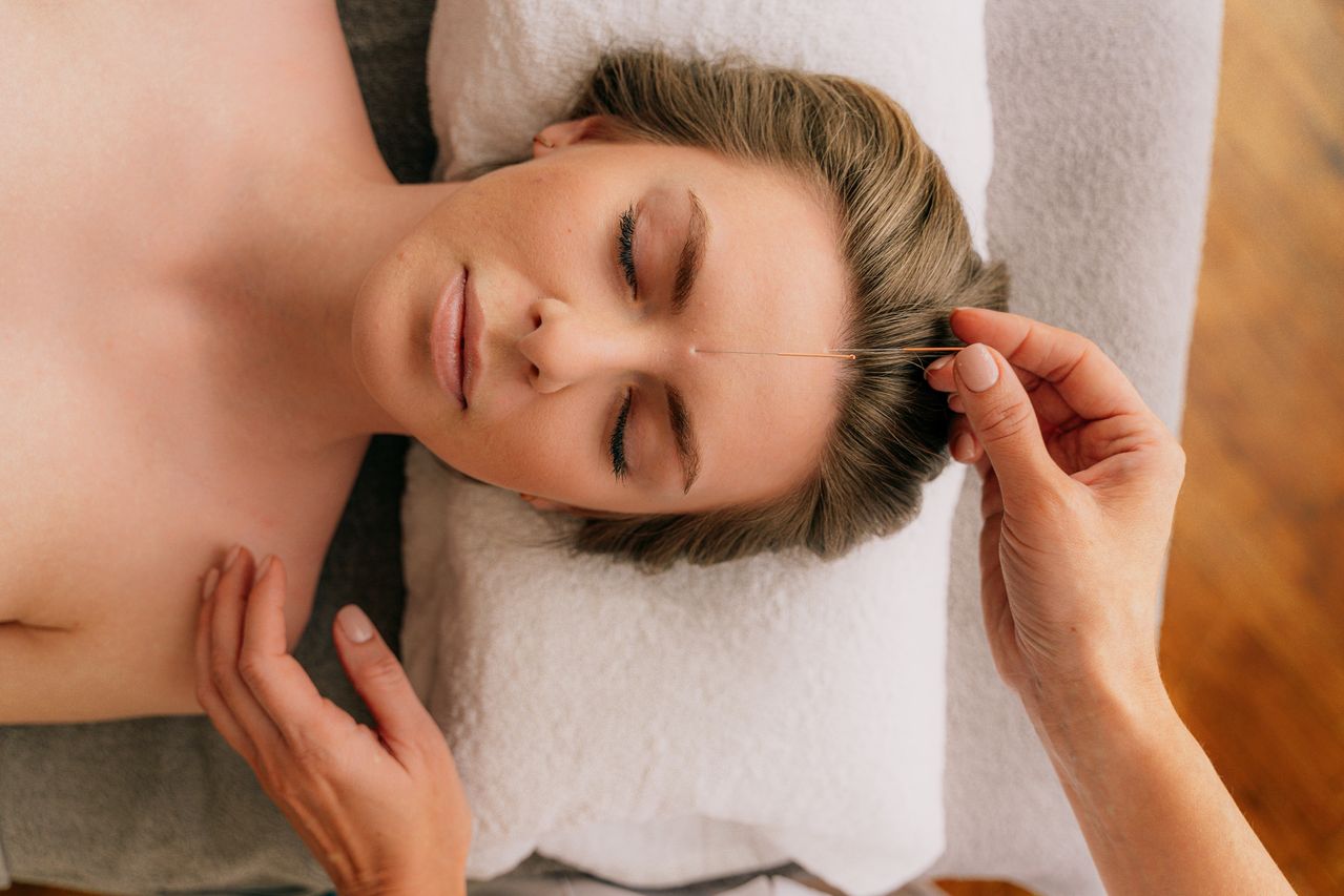 Acupuncture needles being placed at the temple of a relaxed patient during a facial acupuncture treatment.