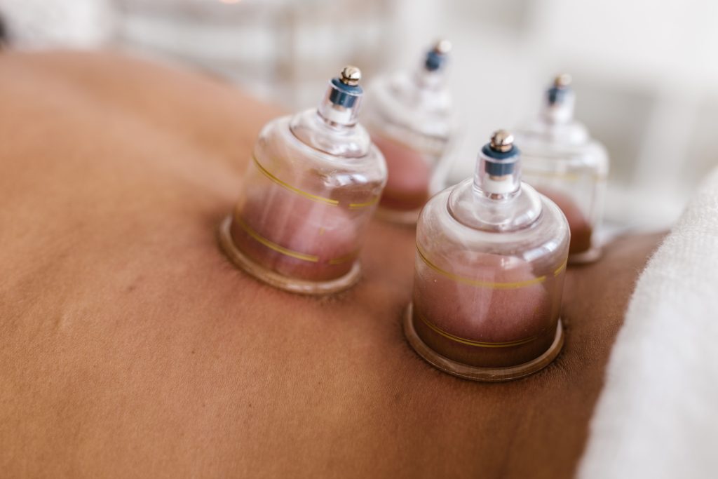 cupping acupuncture