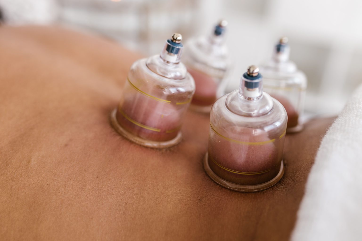cupping acupuncture